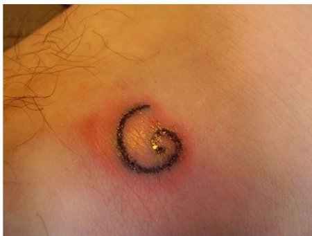 Tattoo Infections Can Be Serious And Should Not Be Left Untreated.